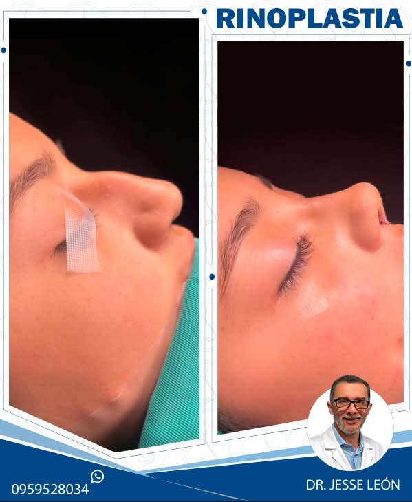 Rinoplastia antes y después